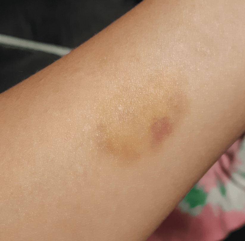 Bite bruise on the arm